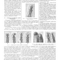 0222 - Page 222 - Travaux originaux. Travail du service du professeur agrégé Moure. Écrasements des doits. Par MM. Marc Iselin et E. Berrocal Uribe