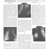 0273 - Page 273 - Travaux originaux. Bronchiectasies abcédées. Abcès bronchiectasiants et abcès bronchiectasiques. Par Emile Sergent