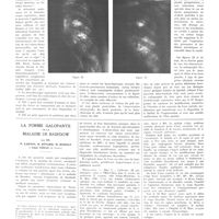 0276 - Page 276 - Travaux originaux. Bronchiectasies abcédées. Abcès bronchiectasiants et abcès bronchiectasiques. Par Emile Sergent / La forme galopante de la maladie de Basedow. Par MM. P. Carnot, H. Bénard, M. Rudolf et Paul Véran...