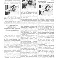 0282 - Page 282 - Travaux originaux. De la valeur thérapeutique des infiltrations péri-articulaires à la novocaïne dans les entorses et les arthrites traumatiques. Par MM. René Leriche et René Fontaine... / Maladies osseuses et troubles du métabolisme calcique. A propos de la guérison de deux cas de maladie de Paget et de Recklinghausen. Par P. Delmas-Marsalet...