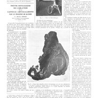 0291 - Page 291 - Travaux originaux. L'angiographie et l'angiopneumographie. Par MM. A. Ravina, A. Sourice et L. Benzaquen / Preuves histologiques de l'ablation de la capsule amygdalienne par le procédé de Sluder. Par Henry Proby...