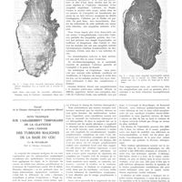 0292 - Page 292 - Travaux originaux. Preuves histologiques de l'ablation de la capsule amygdalienne par le procédé de Sluder. Par Henry Proby... / Travail de la clinique chirurgicale du professeur Bérard. Note technique sur l'abaissement temporaire de la clavicule dans l'exérèse des tumeurs malignes de la base du cou. Par R. Peycelon...