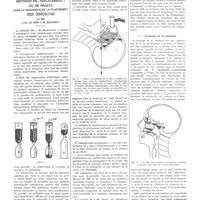 0393 - Page 393 - Travaux originaux. La méthode de «déplacement» ou de Proetz dans le diagnostic et le traitement des sinusites. Par MM. J.-M. Le Mée et M. Bouchet