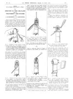 Fig. 1. Dissection de la pulpe terminale, 1er temps / Fig. 2. Dissection de la pulpe terminale, 2e t [...]