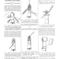 0631 - Page 627 - Travaux originaux. Travail de la clinique de M. le prof. L. Tixier. La résection du tissu cellulaire dans le traitement des panaris. Par MM. J. de Rougemont et F. Carcassonne
