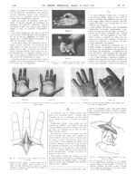 Fig. 7et 8. Résultats d'une dissection du tissu cellulaire de la pulpe terminale du pouce droit / Fi [...]