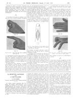 Fig. 15 et 16. Index droit opéré selon la méthode décrite (fig. 14) / Fig. 17. Large dissection du t [...]