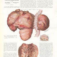 0648 - Page 644 - Travaux originaux. Volumineuse tumeur para-néphrétique (lipo-myxo-sarcome) à évolution abdomino-pelvienne. Par MM. Pierre Brocq... et Pham Huu-Chi...