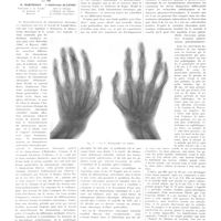 0650 - Page 646 - Travaux originaux. Sur une forme nouvelle de rhumatisme chronique fibreux. Rhumatisme chronique familial et infantile. Par MM. G. Marinesco... et Guillermo Allende...