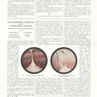 0657 - Page 653 - Travaux originaux. Clinique chirurgicale A de Strasbourg (Professeur René Leriche). Le mucus de la vésicule biliaire. Par MM. René Bauer... A. Chinassi Hakki... / Les adhérences pleurales dans le pneumothorax artificiel. Remarques sur quelques images endoscopiques. Par MM. Daniel Douady... et André Meyer...