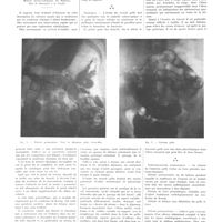 0660 - Page 656 - Travaux originaux. Diagnostic radiologique des sténoses de l'intestin grêle. Par Etienne Piot...