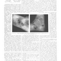0669 - Page 665 - Travaux originaux. La périartérite noueuse (maladie de Kussmaul) à forme chronique. Par MM. M. Macaigne... et P. Nicaud...