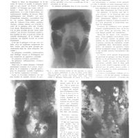 0691 - Page 687 - Travaux originaux. La polypose intestinale. Par MM. Raoul Bensaude, Pierre Hillemand et Pierre Augier