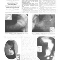 0993 - Page 981 - Travaux originaux. Clinique thérapeutique chirurgicale, hôpital de Vaugirard. L'insufflation de l'estomac en radiologie clinique (pneumo-gastro radiographie). Par MM. Pierre Duval et Henri Béclère