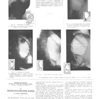 0995 - Page 983 - Travaux originaux. Clinique thérapeutique chirurgicale, hôpital de Vaugirard. L'insufflation de l'estomac en radiologie clinique (pneumo-gastro radiographie). Par MM. Pierre Duval et Henri Béclère / Ospedale del Littorio. Service de chirurgie Morgagni, Rome. (Directeur : prof. Cesare Antonucci). La cholécystographie rapide. Par César Antonucci
