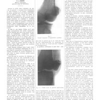 0999 - Page 987 - Travaux originaux. Fractures et fragmentations non traumatiques de la rotule. Étude radiologique. Par J. Didiée...