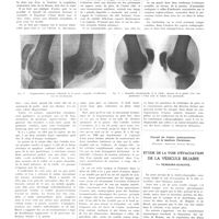 1000 - Page 988 - Travaux originaux. Fractures et fragmentations non traumatiques de la rotule. Étude radiologique. Par J. Didiée... / Travail du centre anticancéreux de la banlieue parisienne (directeur : professeur Gustave Boussy). Étude de la voie d'évacuation de la vésicule biliaire. Par Nemours-Auguste