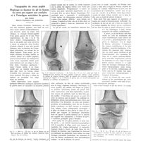 1019 - Page 1007 - Notes de médecine pratique publiées par les soins de A. Ravina. Topographie du creux poplité. Repérage en hauteur du pli de flexion du jarret par rapport aux condyles et à l'interligne articulaire du genou. Son intérêt dans la localisation des projectiles