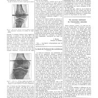 1020 - Page 1008 - Notes de médecine pratique publiées par les soins de A. Ravina. Topographie du creux poplité. Repérage en hauteur du pli de flexion du jarret par rapport aux condyles et à l'interligne articulaire du genou. Son intérêt dans la localisation des projectiles / La durée de l'isolement des scarlatineux / Un nouveau traitement de l'intoxication saturnine