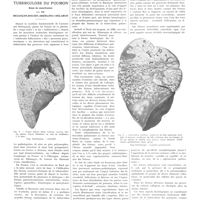 1105 - Page 1093 - Travaux originaux. Les formes anatomiques de la tuberculose du poumon. Essai de classification. Par MM. Bezançon, Roussy, Oberling et Delarue