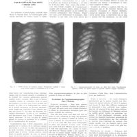 1110 - Page 1098 - Travaux originaux. L'angiopneumographie et son application dans la tuberculose pulmonaire. Par MM. Lopo de Carvalho, Egas Moniz et Almeida Lima