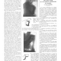 1118 - Page 1106 - Travaux originaux. Contribution à l'étude des troubles gastriques consécutifs à la phrénicectomie volvulus de l'estomac. Par MM. Bonafé et Poulain... / Travail de la clinique thérapeutique chirurgicale de la Faculté de Paris (Professeur P. Duval). Réduction sous l'écran des fractures de l'extrémité inférieure du radius. Par Merle d'Aubigné