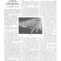 1281 - Page 1269 - Travaux originaux. Rétrécissement inflammatoire du rectum. Hippocratisme digital et rhumatisme infectieux. Par MM. P. Moulonguet et J. Salomon