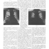 1416 - Page 1404 - Travaux originaux. Les indications et les limites de la pleuroscopie. Par MM. Ch.-A. Piguet et Willy Froehlich