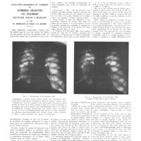 1505 - Page 1493 - Travaux originaux. Évolution régressive et guérison de gommes géantes du poumon suivies sous l'écran. Par MM. Pr. Merklen, M. Wolf et D. Sichel