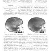 1511 - Page 1499 - Travaux originaux. Le nodule silicotique pulmonaire. Par A. Policard. Bibliographie / La visibilité des sinus de la dure-mère par l'épreuve encéphalographique. Par MM. Egas Moniz, Abel Alves et Fernando de Almeida...