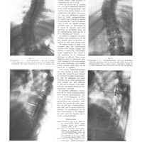 1520 - Page 1508 - Travaux originaux. Clinique médicale du prof Dr. Kr. Hynekl à Prague. Nouvelle méthode décompressive et évacuatrice de la cavité syringomyélique par ponction faite à son pôle inférieur. Ponction bipolaire de la cavité syringomyélique. Par Jirl Vitek... / Bibliographie