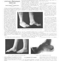 1749 - Page 1733 - Travaux originaux. La dystasie aréflexique héréditaire. Par Gustave Roussy et Gabrielle Lévy