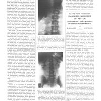 1755 - Page 1739 - Travaux originaux. Nouvelles méthodes d'examen clinique et radiologique du foie. Par M. le professeur Karlo Radonicic... / Sur une forme particulière d'angiome caverneux du rectum. L'angiome cutanéo-muqueux ou génito-périnéo-rectal. Par R. Bensaude et A. Bensaude