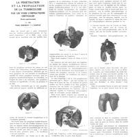 1933 - Page 1917 - Travaux originaux. La pénétration et la propagation de la tuberculose par les voies lymphatiques cervicales. Étude expérimentale. Par MM. Émile Sergent et I. Gaspar