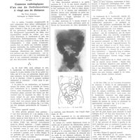 1971 - Page 1955 - Petites cliniques de «La Presse médicale» N° 231. Examens radiologiques d'un cas de dolichocolons à vingt ans de distance. Par Paul Aubourg...