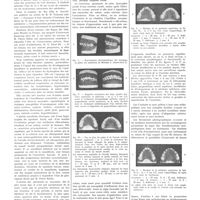 1990 - Page 1974 - Notes de médecine pratique publiées par les soins de A. Ravina. La correction précoce des atrésies maxillaires