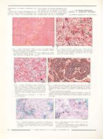 Fig. 4. Adénome chromophobe à cellules de grossesse / Fig. 5. Adénome chromophobe à cellules claires [...]