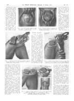 Fig. 3. En suivant le rebord supérieur de l'incision cutanée, on sectionne de dehors en dedans, sans [...]