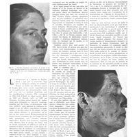 0150 - Page 146 - Travaux originaux. La maladie de Besnier-Boeck. Ses manifestations cutanées, ganglionnaires, pulmonaires, osseuses, viscérales, nasales et conjonctivales. Par L.-M. Pautrier