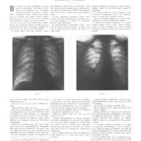 0154 - Page 150 - Travaux originaux. Diagnostic radiologique des kystes hydatiques suppurés du poumon. Par MM. H. Constantin et E. Curtillet