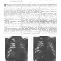 0160 - Page 156 - Travaux originaux. Considérations sur les hernies du médiastin et en particulier sur leur pathogénie. Par MM. F. Triboulet... et J. Lecoeur...
