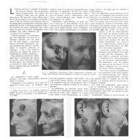 0163 - Page 159 - Notes de médecine pratique dermatologie. Publiées par les soins de A. Sézary. Indications et idées directrices du traitement électro-chirurgical des cancers de la peau
