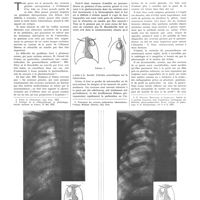 0389 - Page 385 - Travaux originaux. Le traitement des cavernes géantes par le pneumothorax. Par MM. Pierre Pruvost, André Meyer et Livieratos