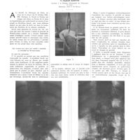 0399 - Page 395 - Travaux originaux. Contribution à l'étude des fractures de la colonne vertébrale. Un procédé de mise en Iordose. Par Raphaël Schotte... (Directeur : Prof. F. De Beule)