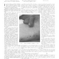 0403 - Page 399 - Travaux originaux. Métastase strepto-bacillaire profonde dans un cas de chancre mou phagédénique. Par MM. A. Banciu..., A. Maisler... et C. Popesco...