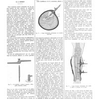 0433 - Page 429 - Travaux originaux. La contention des fractures diaphysaires obliques ou comminutives. Par J. Gosset
