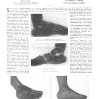 0562 - Page 558 - Travaux originaux. Blastomycose osseuse simulant l'aspect «d'une scaphoïdite tarsienne des jeunes enfants». Par MM. Marcel Meyer..., A.-R. Sartory et J. Meyer...