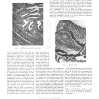 0572 - Page 568 - Travaux originaux. Métastase cancéreuse de l'acromion secondaire à un cancer cylindrique du corps utérin, opéré depuis plus de six ans et non récidivé localement. Par Henry Fobe
