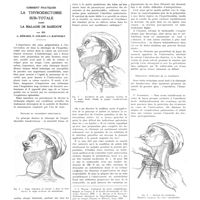 0685 - Page 681 - Travaux originaux. Comment pratiquer la thyroïdectomie sub-totale dans la maladie de Basedow. Par MM. L. Bérard, P. Colson et I. Raponsky