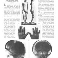 0790 - Page 786 - Travaux originaux. Progeria. Étude des lésions du système osseux. Par René Broc, Marcelle Nicolle et A. Jaubert de Beaujeu...